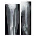 Alternate Image #4 of Broken Bones X-Rays