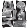 Alternate Image #5 of Broken Bones X-Rays