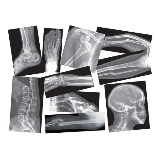 Broken Bones X-Rays