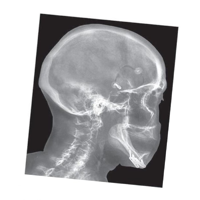 Alternate Image #1 of Broken Bones X-Rays