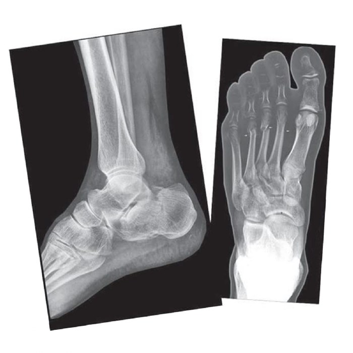 Alternate Image #1 of Broken Bones X-Rays