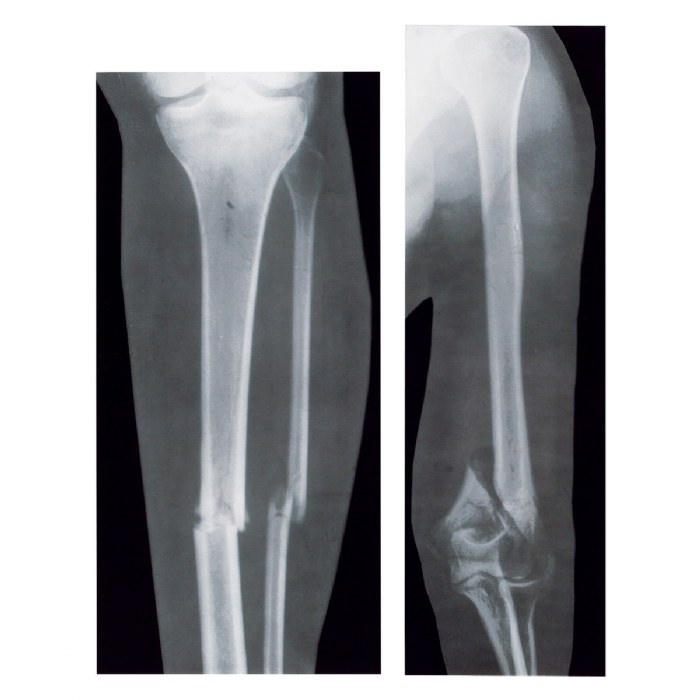 Alternate Image #1 of Broken Bones X-Rays