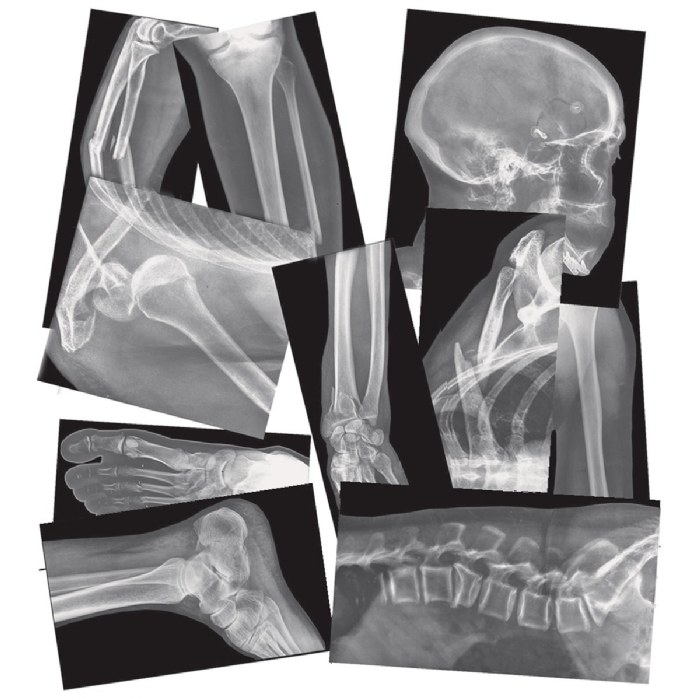Alternate Image #1 of Broken Bones X-Rays