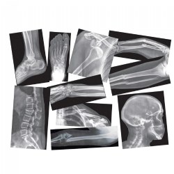 Image of Broken Bones X-Rays