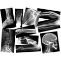 Thumbnail Image of Broken Bones X-Rays