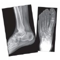 Alternate Image #3 of Broken Bones X-Rays