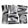 Broken Bones X-Rays